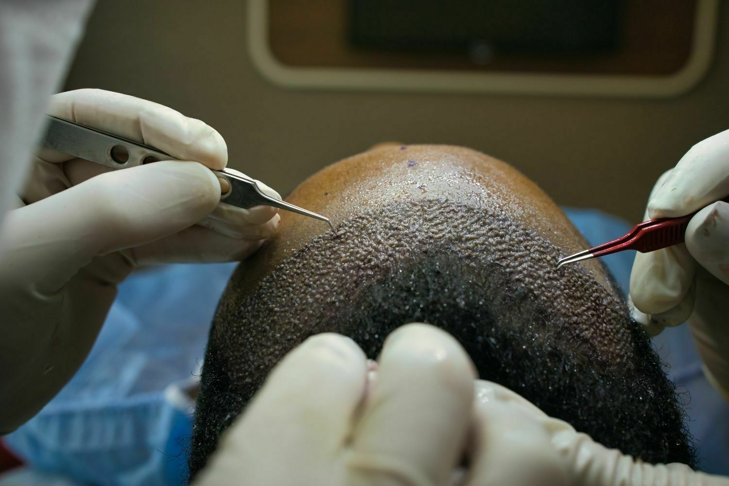 Hair Transplantation