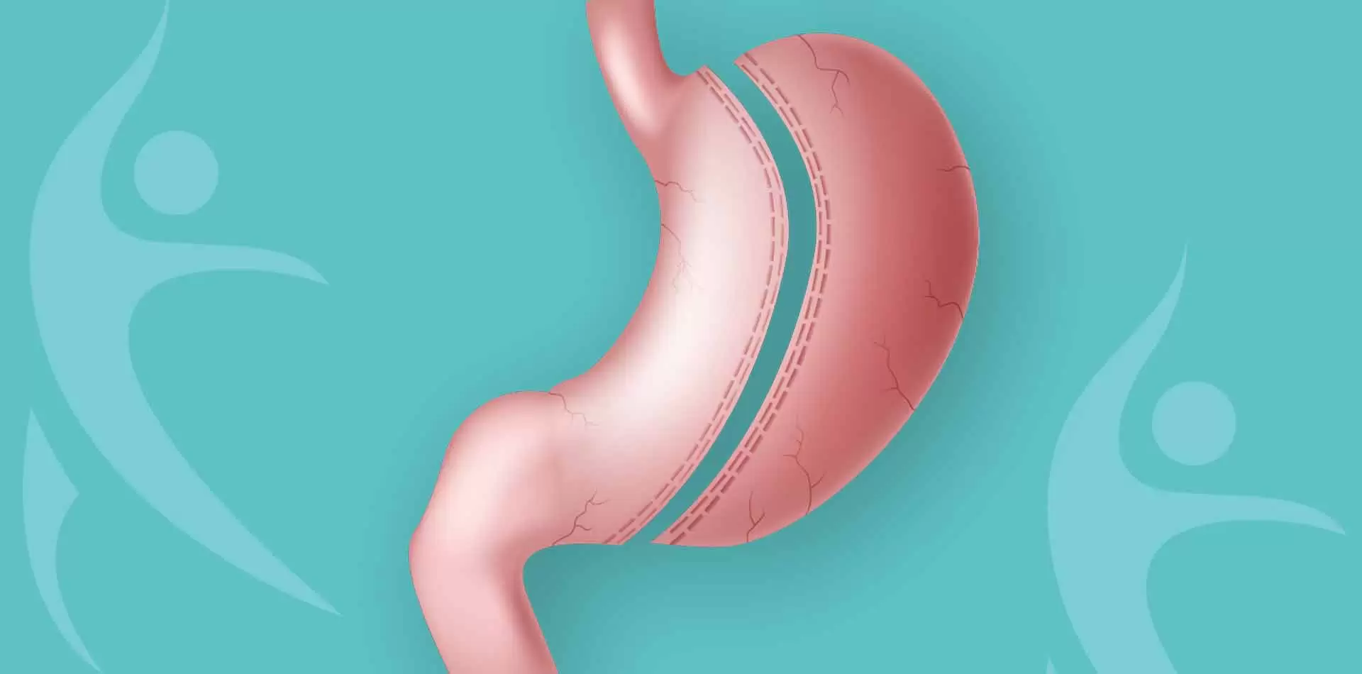 Gastric Sleeve (Sleeve Gastrectomy)