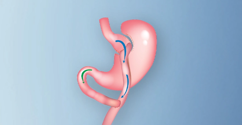 Gastric Bypass